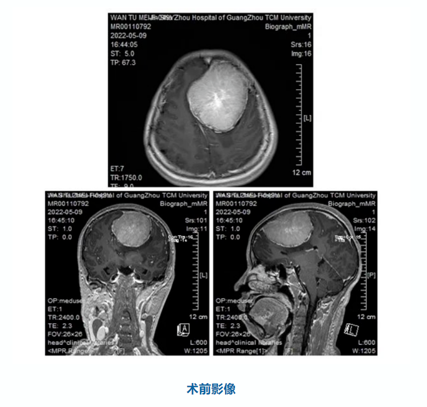 廣州中醫藥大學金沙洲醫院神經醫(yī)學高(gāo)難度腦(nǎo)膜瘤手術(shù)圓滿成功! 廣州中醫藥大學金沙洲醫院神經醫(yī)學高(gāo)難度腦(nǎo)膜瘤手術(shù)圓滿成功!