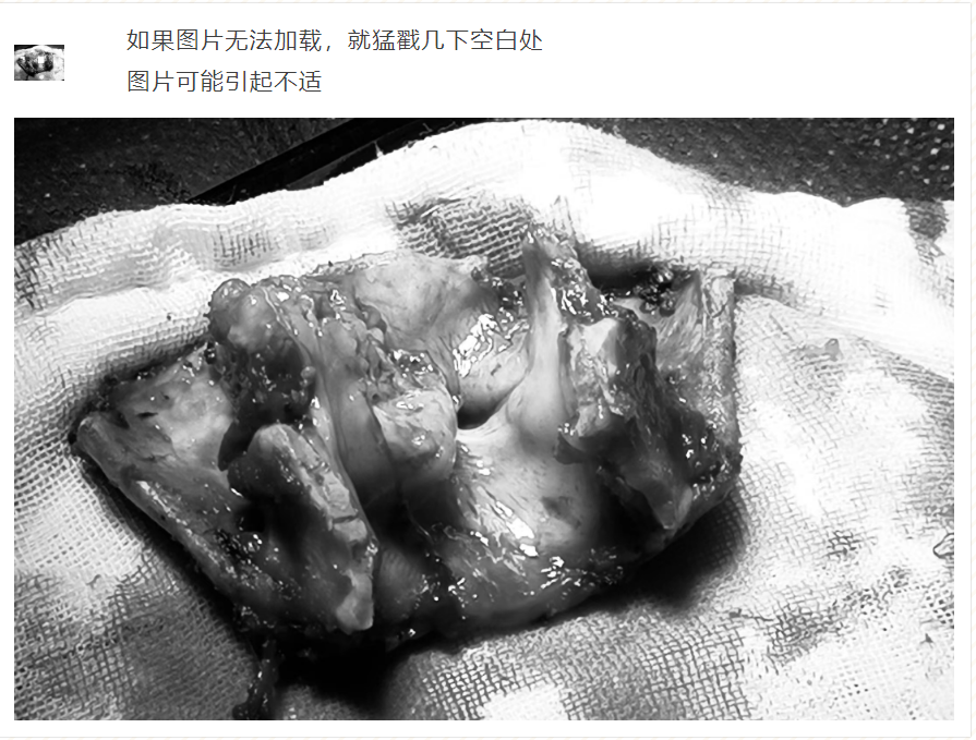 我院耳鼻咽喉頭頸外科團隊成功開(kāi)展全喉切除手術(shù) 我院耳鼻咽喉頭頸外科團隊成功開(kāi)展全喉切除手術(shù)