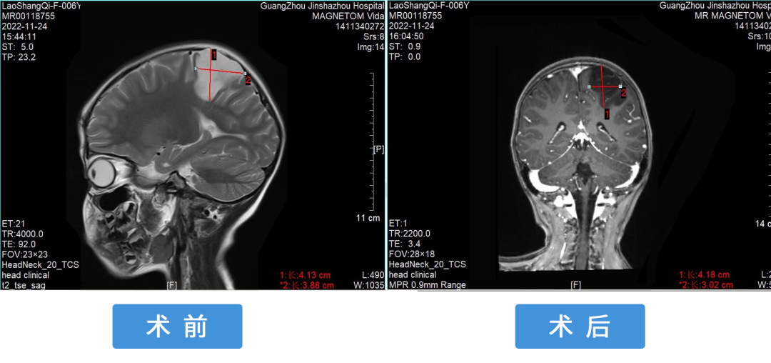 7歲小(xiǎo)女孩患腦(nǎo)膠質瘤并發癫痫症,神經醫(yī)學專家(jiā)專業化治療,圓滿成功! 7歲小(xiǎo)女孩患腦(nǎo)膠質瘤并發癫痫症,神經醫(yī)學專家(jiā)專業化治療,圓滿成功!