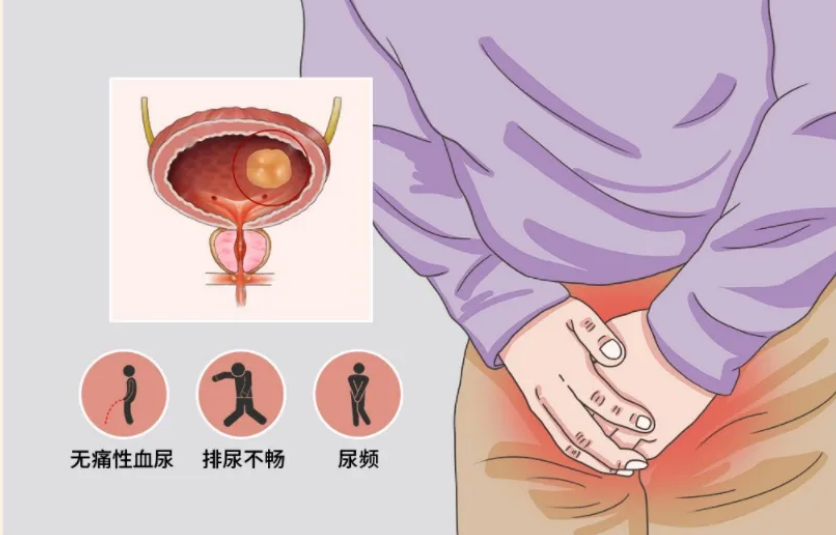 膀胱癌的護理(lǐ)你(nǐ)get多(duō)少(shǎo)？