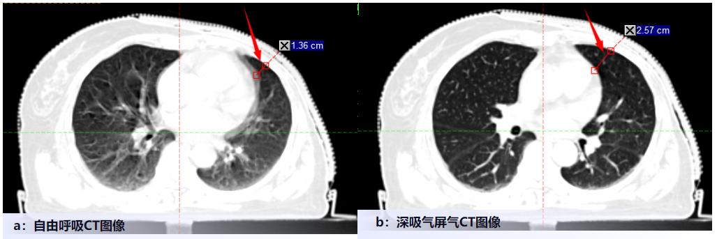 乳腺癌DIBH治療之呼吸“随心”，不傷心