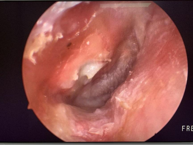 病例分享|耳內(nèi)鏡手術(shù)，精準微創治療耳科疾患