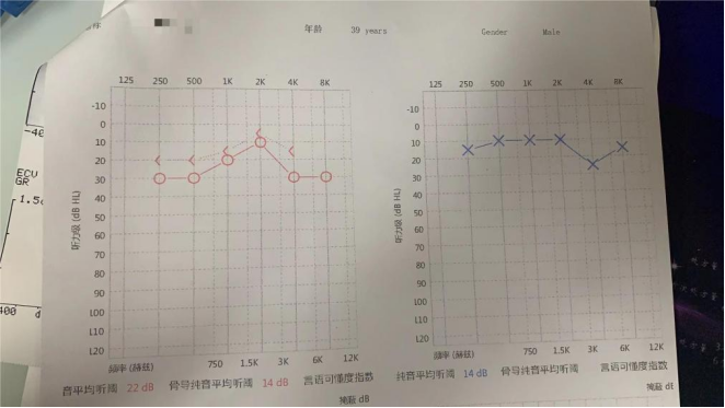 病例分享|耳內(nèi)鏡手術(shù)，精準微創治療耳科疾患