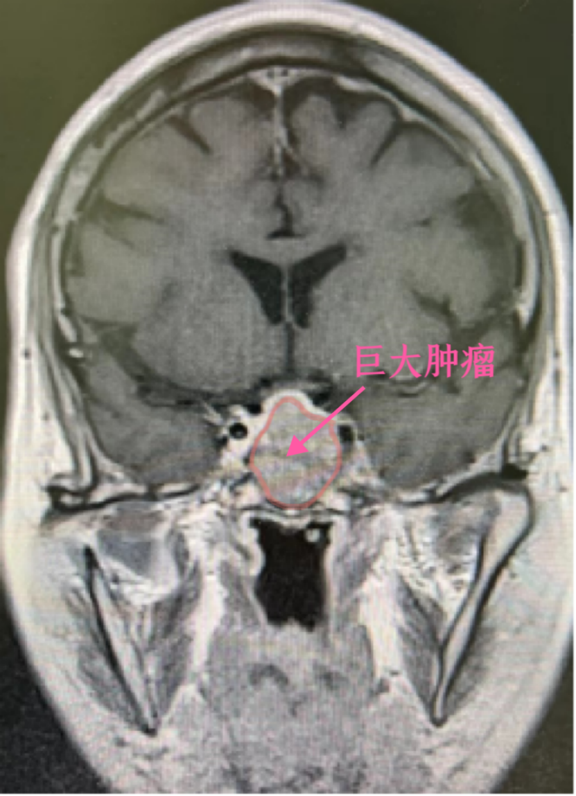 病例分享|伽瑪刀，為(wèi)高(gāo)齡腦(nǎo)腫瘤患者帶來(lái)生(shēng)命的希望