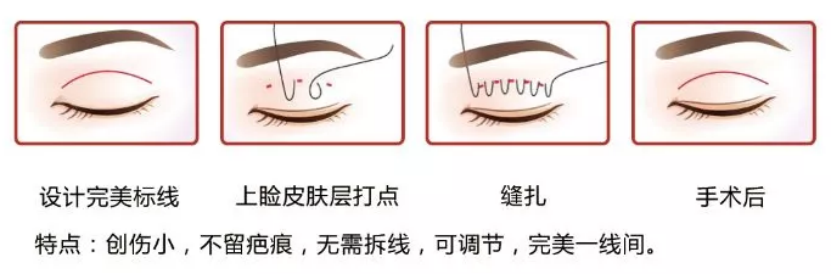 大(dà)衆科普|眼周美容微整形攻略,請(qǐng)您查收~ 大(dà)衆科普|眼周美容微整形攻略,請(qǐng)您查收~