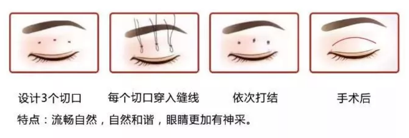 大(dà)衆科普|眼周美容微整形攻略,請(qǐng)您查收~ 大(dà)衆科普|眼周美容微整形攻略,請(qǐng)您查收~