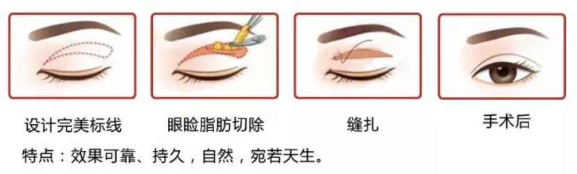 大(dà)衆科普|眼周美容微整形攻略,請(qǐng)您查收~ 大(dà)衆科普|眼周美容微整形攻略,請(qǐng)您查收~