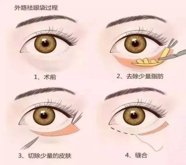 大(dà)衆科普|眼周美容微整形攻略,請(qǐng)您查收~ 大(dà)衆科普|眼周美容微整形攻略,請(qǐng)您查收~