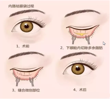 大(dà)衆科普|眼周美容微整形攻略,請(qǐng)您查收~ 大(dà)衆科普|眼周美容微整形攻略,請(qǐng)您查收~