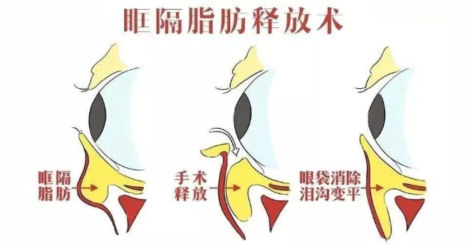 大(dà)衆科普|眼周美容微整形攻略,請(qǐng)您查收~ 大(dà)衆科普|眼周美容微整形攻略,請(qǐng)您查收~