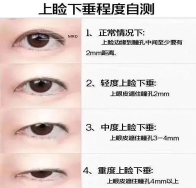 大(dà)衆科普|眼周美容微整形攻略,請(qǐng)您查收~ 大(dà)衆科普|眼周美容微整形攻略,請(qǐng)您查收~