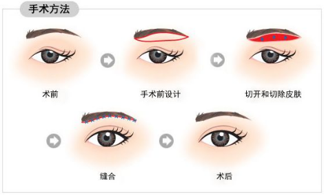 大(dà)衆科普|眼周美容微整形攻略,請(qǐng)您查收~ 大(dà)衆科普|眼周美容微整形攻略,請(qǐng)您查收~