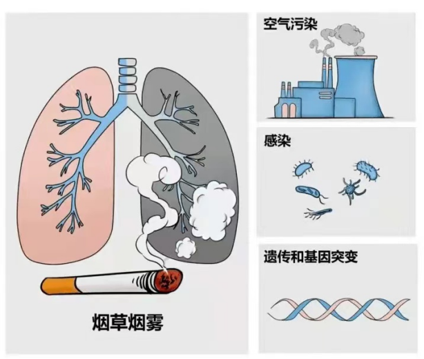 世界慢性阻塞性肺炎日|肺系生(shēng)命,刻不容緩 世界慢性阻塞性肺炎日|肺系生(shēng)命,刻不容緩