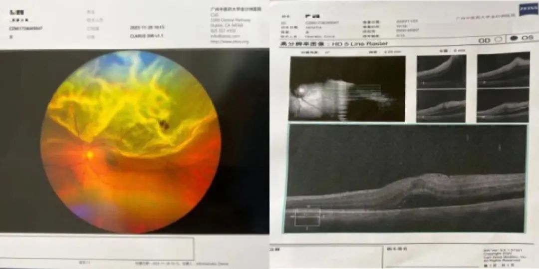 病例分享|突破光明(míng)禁區(qū)：廣州中醫藥大學金沙洲醫院眼科中心首例微創玻璃體(tǐ)視(shì)網膜手術(shù)