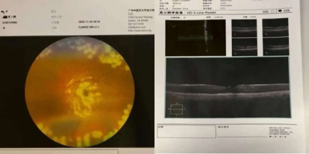 病例分享|突破光明(míng)禁區(qū)：廣州中醫藥大學金沙洲醫院眼科中心首例微創玻璃體(tǐ)視(shì)網膜手術(shù)