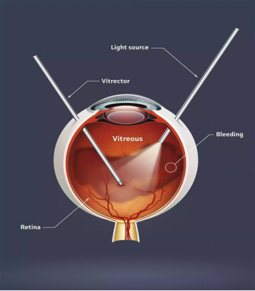 病例分享|突破光明(míng)禁區(qū)：廣州中醫藥大學金沙洲醫院眼科中心首例微創玻璃體(tǐ)視(shì)網膜手術(shù)