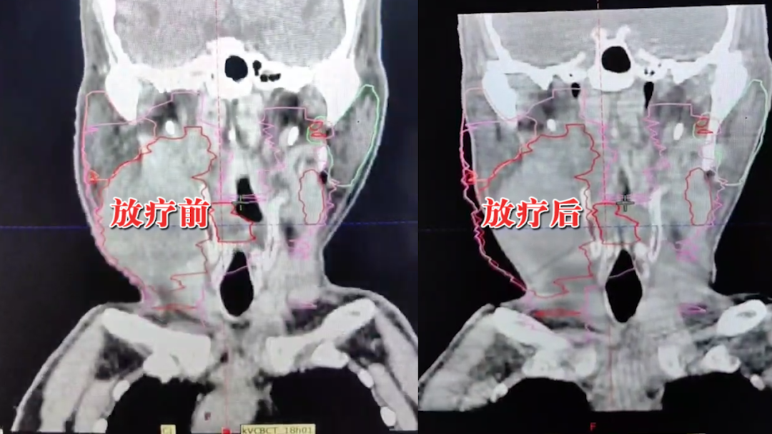 病例分享|個(gè)性化精準方案縮瘤，患者連送錦旗緻謝