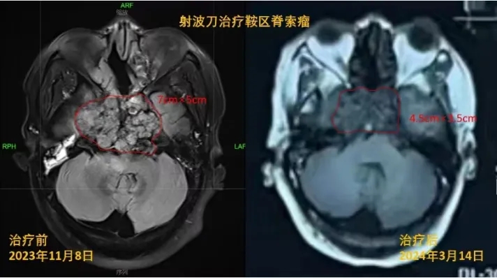 病例分享|長在大(dà)腦(nǎo)深處的腫瘤，不開(kāi)刀也能“切”