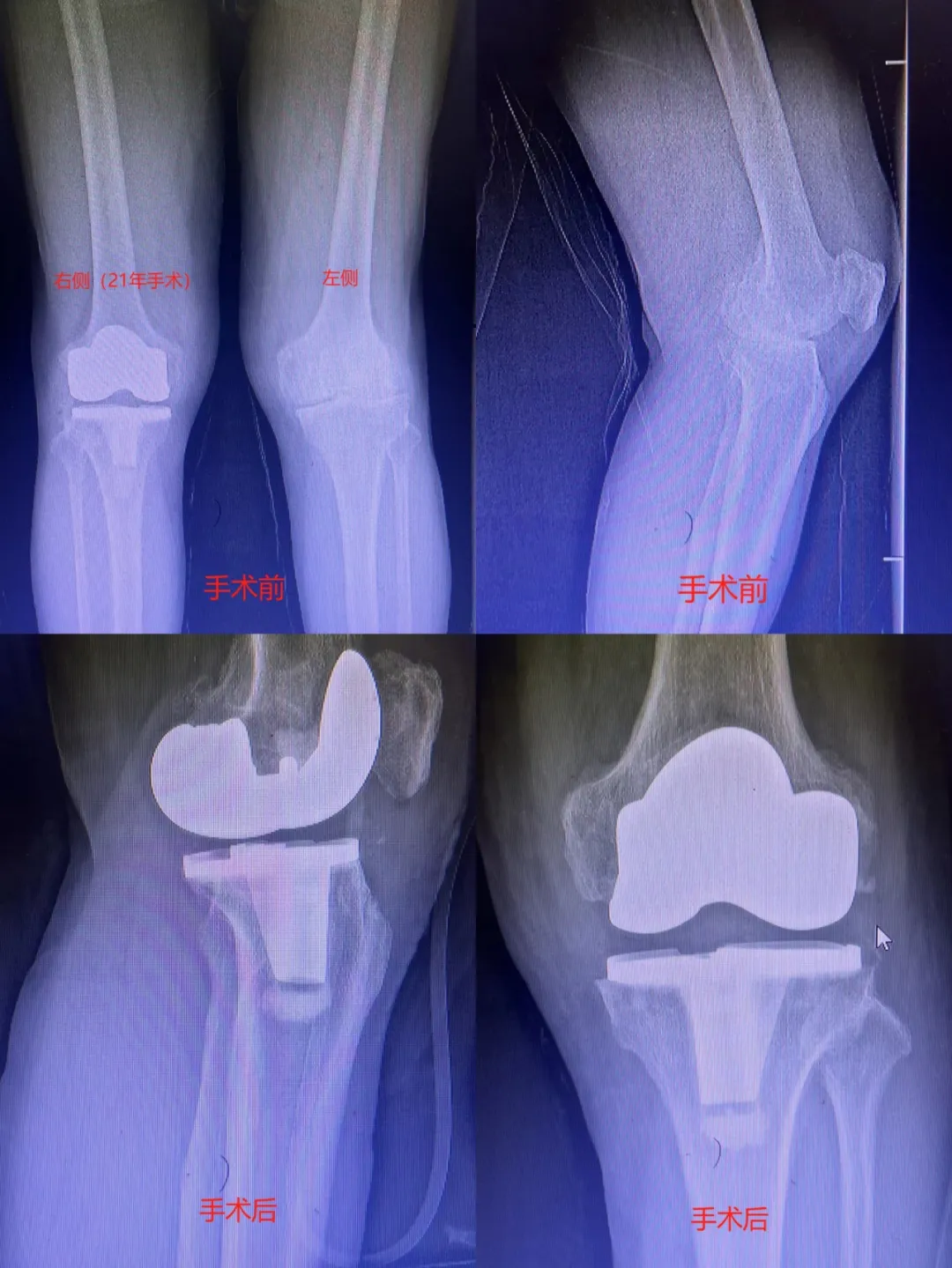 病例分享|膝關節置換術(shù)，一天重獲新“膝”望